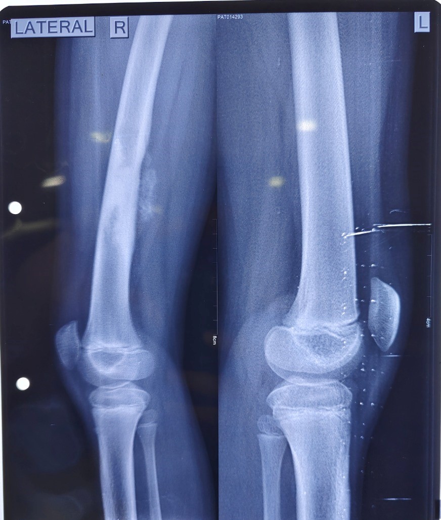 बालको मेडिकल सेंटर के विशेषज्ञों ने की बोन कैंसर की दुर्लभ सर्जरी और पुन:र्निर्माण