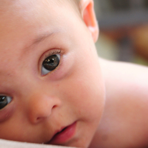  डाउन सिन्ड्रोम क्या है?