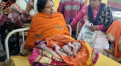 बिहार के कटिहार में 4 हाथ और 4 पैर वाले बच्चे का जन्म, तस्वीर हुई वायरल