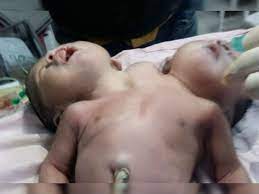 दो सिर और तीन हाथ वाले बच्चे क्यों पैदा होते हैं?