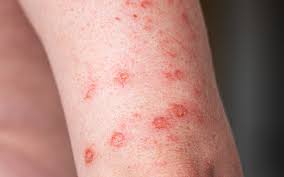 त्वचा पर होने वाले चकत्ते क्या हैं? आनुवंशिक ‘फिंगरप्रिंट’ उपचार में हो सकते हैं मददगार