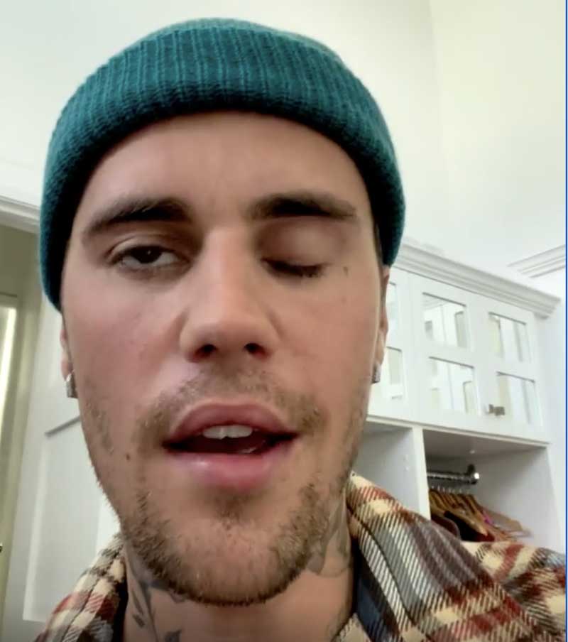 Ramsay Hunt Syndrome: जस्टिन बीबर को आख़िर क्या बीमारी है