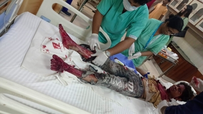 घर में पटाखा बना रहे दो किशोर घायल, एक ने दोनों हाथ गंवाए घर में पटाखा बना रहे दो किशोर घायल, एक ने दोनों हाथ गंवाए
