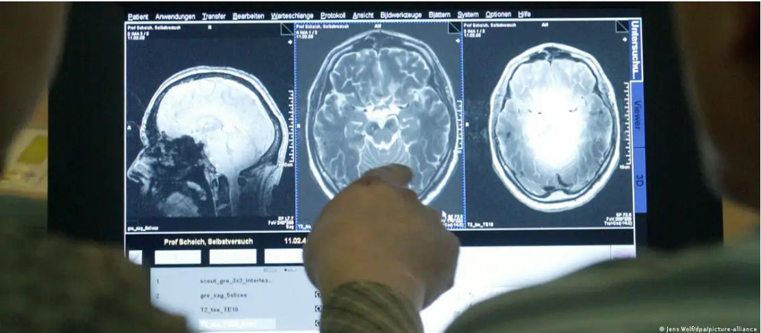 दिमाग की कोशिकाओं की मौत का रहस्य सुलझा