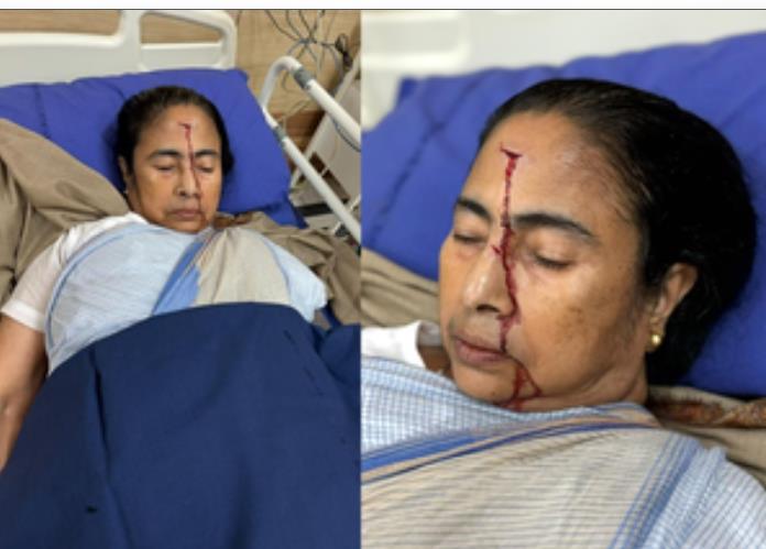 वरिष्ठ डॉक्टर और तृणमूल मंत्री का दावा, सीएम ममता बनर्जी की चोट क्षणिक बेहोशी का नतीजा वरिष्ठ डॉक्टर और तृणमूल मंत्री का दावा, सीएम ममता बनर्जी की चोट क्षणिक बेहोशी का नतीजा