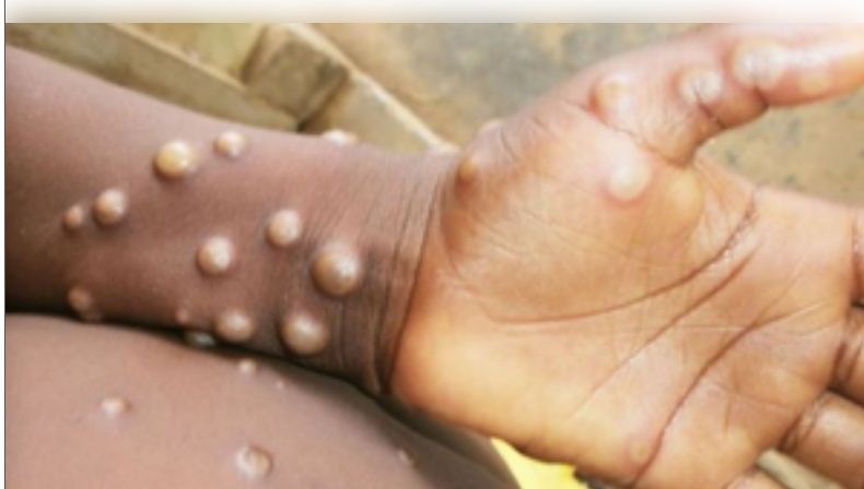 जयपुर एयरपोर्ट पर मंकीपॉक्स का संदिग्ध मामला, आरयूएचएसएच भेजा गया मरीज 