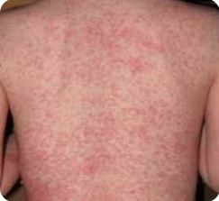 घमोरियां, और उसके दिलचस्प पहलू