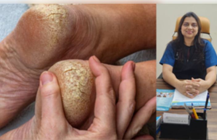 सही त्वचा देखभाल से अब फटी एड़ियों को कहें बॉय-बॉय