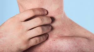 अमेरिका में खसरे की पिछले कुछ दशकों में सबसे बड़ी लहर, एक अन्य बच्चे की मौत