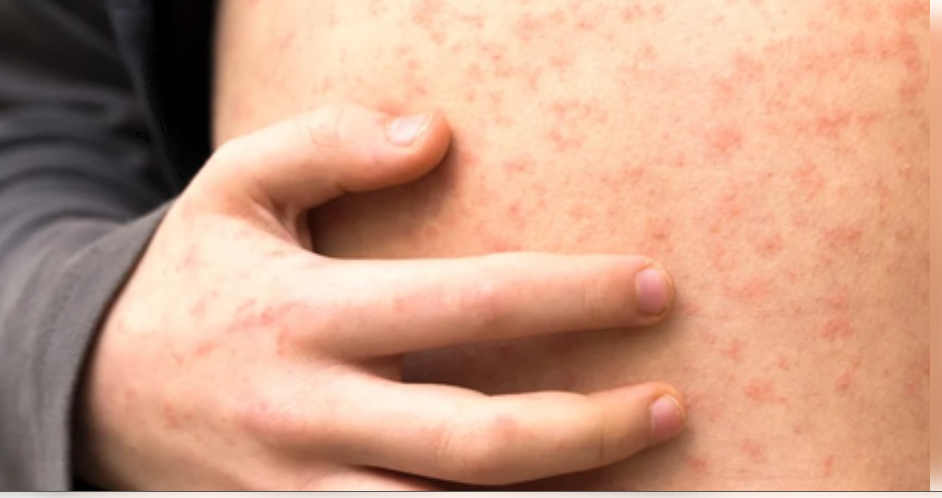 अमेरिका में ‘खसरे’ ने बढ़ाई चिंता, टेक्सास में 700 से अधिक बीमार 