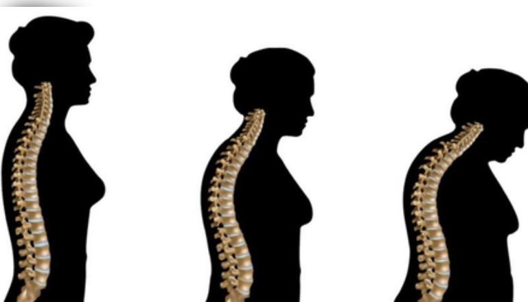 महिलाओं में कैल्शियम की कमी बन रही है बड़ी परेशानी, ऑस्टियोपोरोसिस जैसी बीमारी का खतरा 