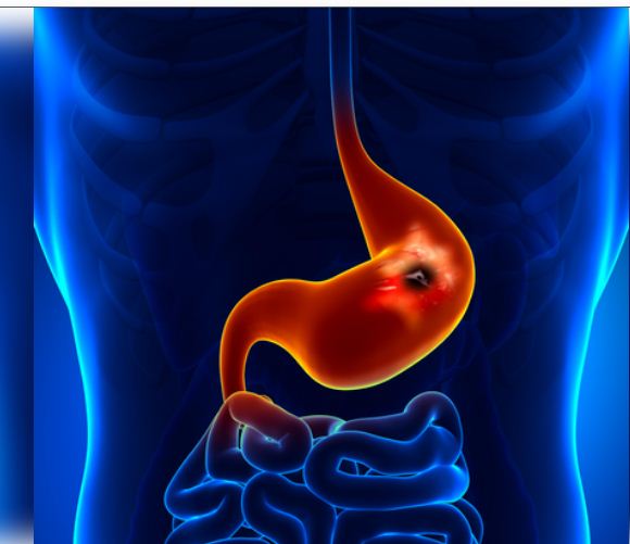 पेट में जलन, दर्द और भारीपन को न करें नजरअंदाज, हो सकते हैं अल्सर के संकेत