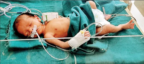 बंदर ने नवजात को मां की गोद से छीनकर कुएं में फेंका, डायपर और नर्स की सूझबूझ से बची जान