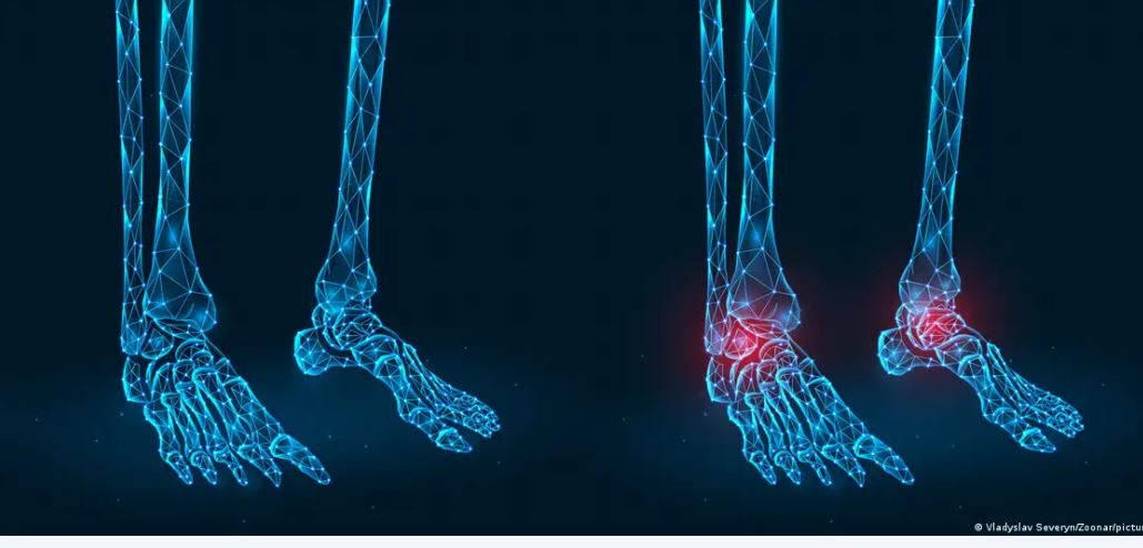 शरीर के एक प्रोटीन से होगा हड्डी रोगों का पूरा इलाज