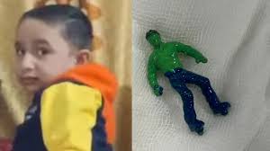 अहमदाबाद में डॉक्टरों ने मासूम के पेट से निकाला प्लास्टिक का खिलौना