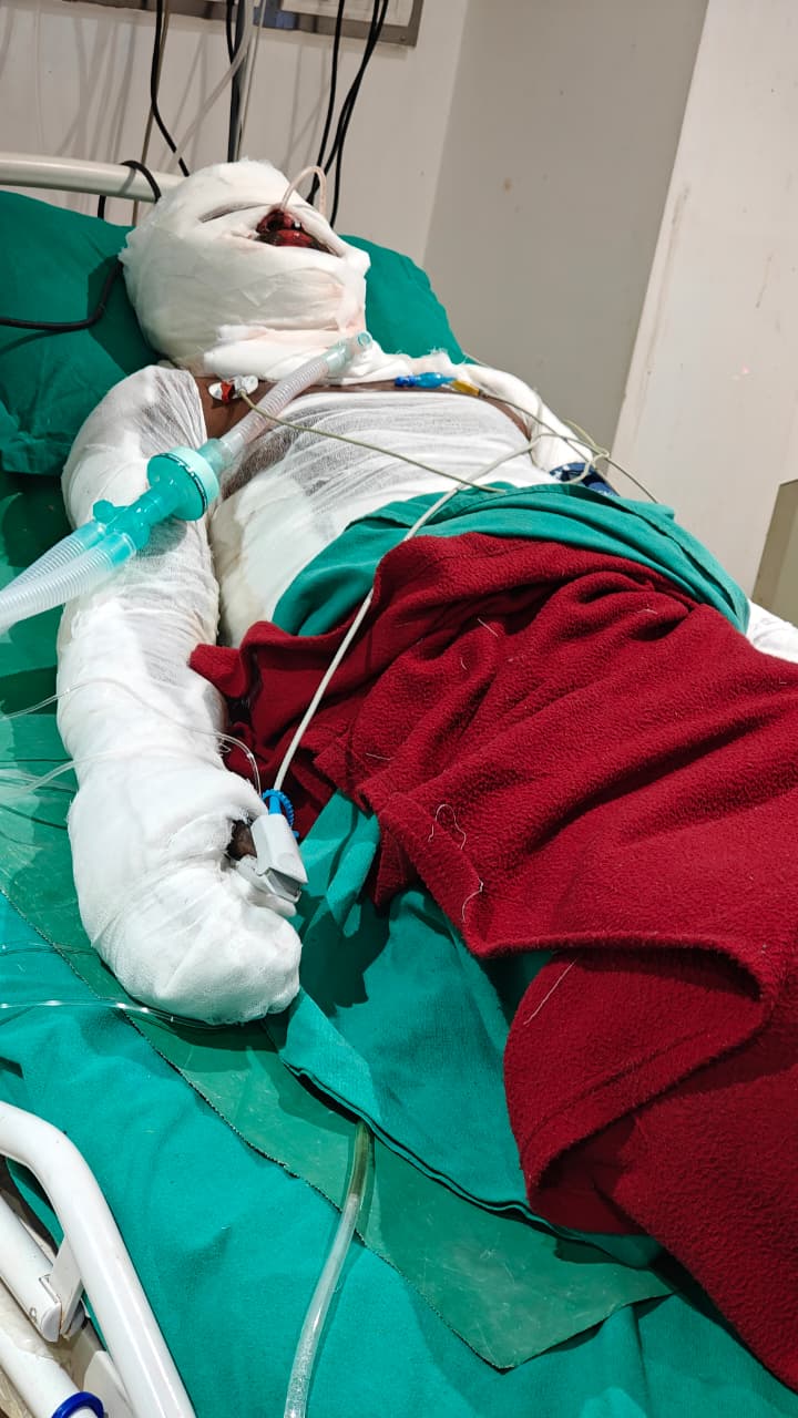 खरसिया औद्योगिक दुर्घटना: 9 माह की बच्ची की मौत, कई मजदूर भर्ती