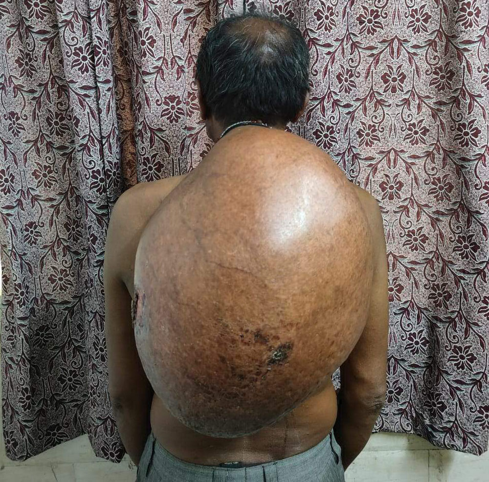 साढ़े 10 किलो का ट्यूमर निकाल डॉक्टरों ने रचा इतिहास