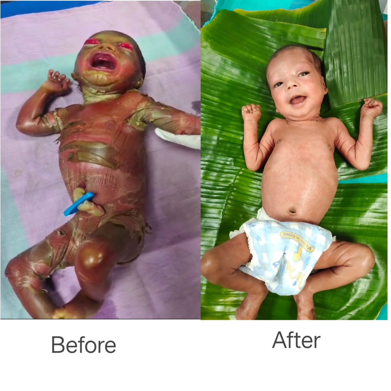 सुदूर बीजापुर में चिकित्सा चमत्कार : अत्यंत दुर्लभ बीमारी से जूझते शिशु को बचाया