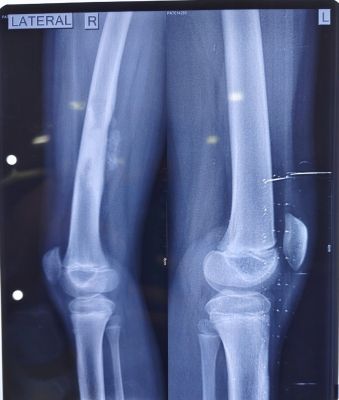 बालको मेडिकल सेंटर के विशेषज्ञों ने की बोन कैंसर की दुर्लभ सर्जरी और पुन:र्निर्माण