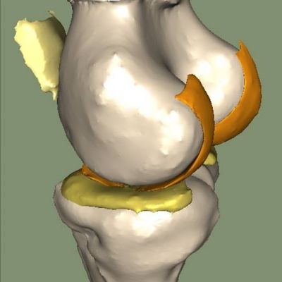 कम्प्यूटर असिस्टेड सर्जरी क्या है?