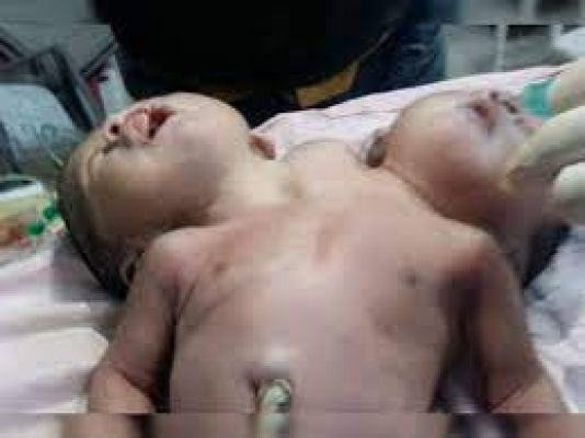 दो सिर और तीन हाथ वाले बच्चे क्यों पैदा होते हैं?