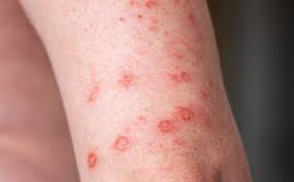 त्वचा पर होने वाले चकत्ते क्या हैं? आनुवंशिक ‘फिंगरप्रिंट’ उपचार में हो सकते हैं मददगार
