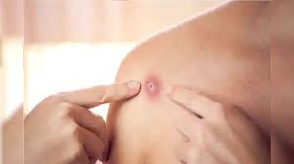 मंकीपॉक्स ने पसारे पैर, 70 से ज्यादा मामलों की पुष्टि, बेल्जियम में समलैंगिकों का फेस्टिवल बना सुपर स्प्रैडर