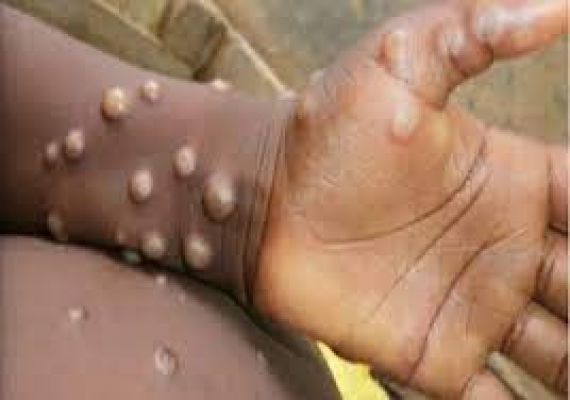 स्पेन में मंकीपॉक्स से एक व्यक्ति की मौत