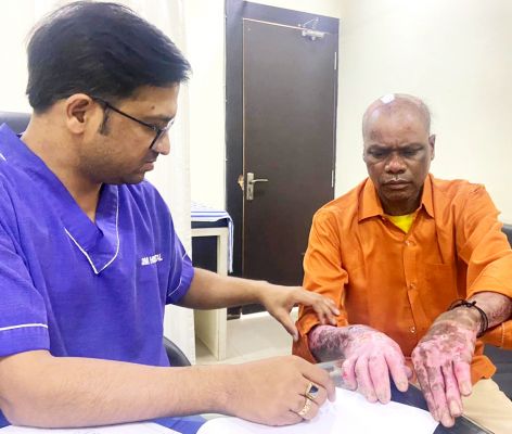 80 प्रतिशत जला मरीज ओम हॉस्पिटल में हुआ स्वस्थ्य