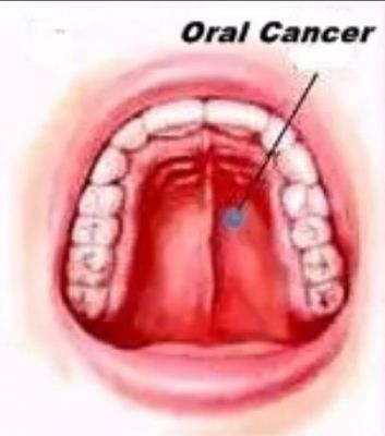 धुआं रहित तंबाकू, सुपारी के कारण भारत में मुंह के कैंसर के मामले दक्षिण एशिया में सबसे ज्यादा : लैंसेट