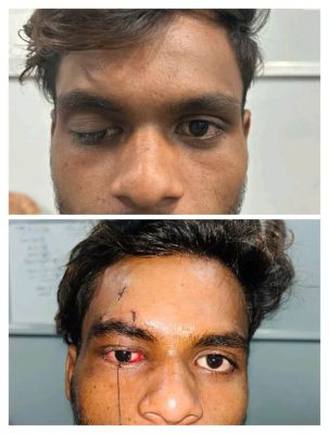 बिलासपुर सिम्स में आंख की दोहरी समस्या का  इलाज, मरीज को मिली नई रोशनी