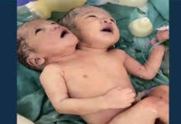 मप्र: इंदौर में जन्मी दो सिर वाली बच्ची, जान बचाने की जद्दोजहद में जुटे चिकित्सक