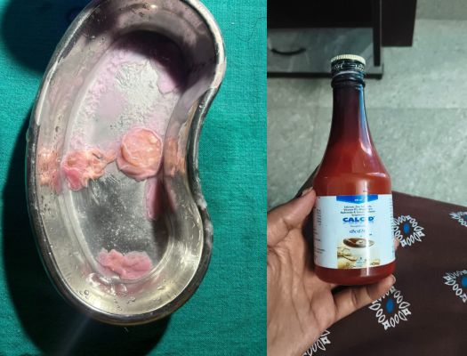 प्रसूता को दिए सिरप में मांस का टुकड़ा, देवपुरी अस्पताल का मामला 