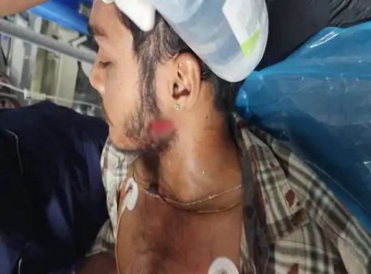 रोड रेज विवाद: युवक के चेहरे-सीने और जांघ में हमला, बदमाश गिरफ्तार 