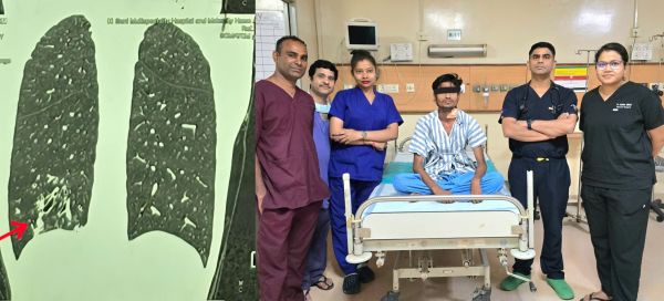 10 साल से खाँसी में खून निकल रहा था, ‘लंग स्टेपलर’ तकनीक स  सर्जरी