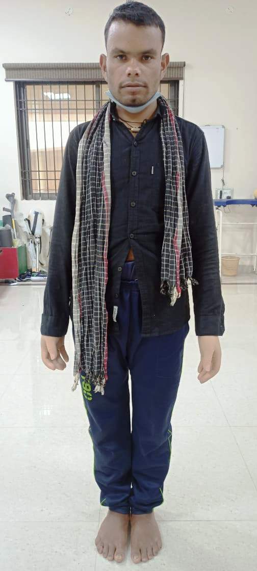 मंत्री अमरजीत भगत के सहयोग से दिव्यांग मोहर को मिला कृत्रिम हाथ