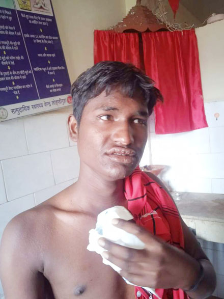 मोबाइल फटने से युवक घायल