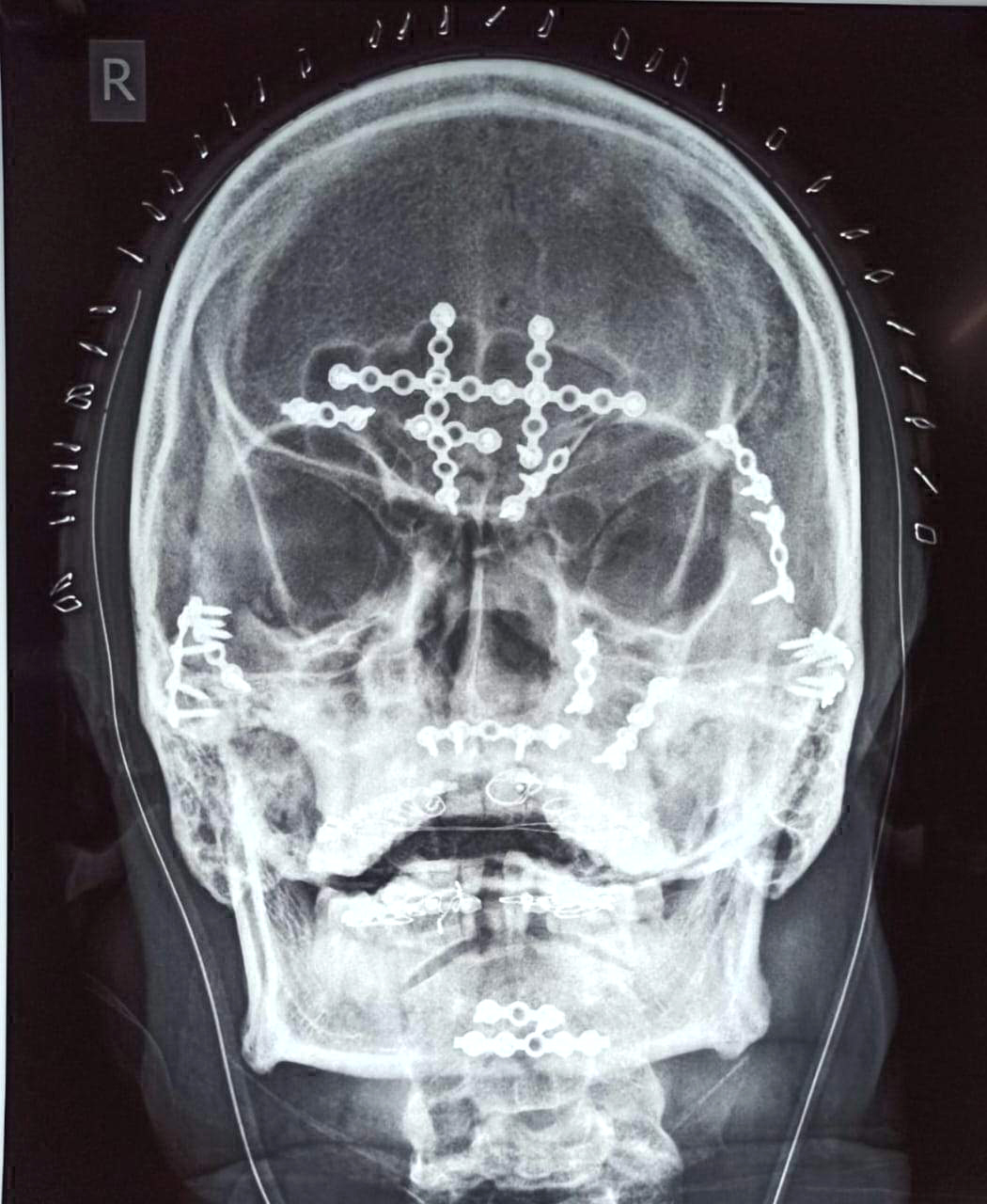  क्षतिग्रस्त चेहरे को 8 घंटे का ऑपरेशन कर विकृत होने से बचाया सिम्स के डॉक्टरों ने