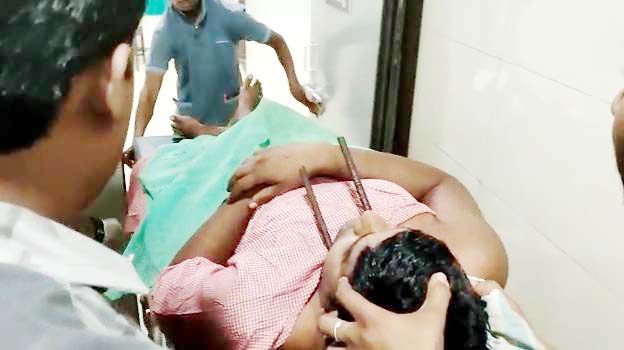  खंभे से गिरा लाइनमैन के रॉड गले के पार, हौसले से बचा