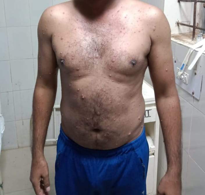 सीआईएसएफ के 2 और जवान पहुँचे मेकाज, मंकी पॉक्स की बनी है आशंका सीआईएसएफ के 2 और जवान पहुँचे मेकाज, मंकी पॉक्स की बनी है आशंका