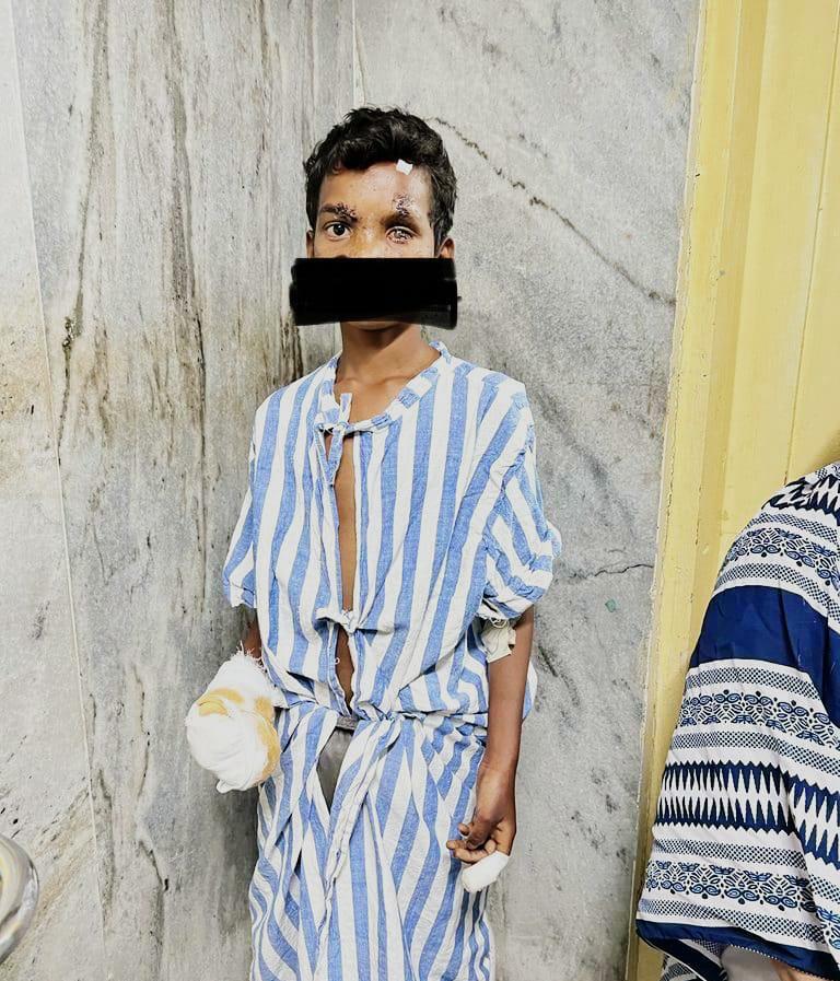 फोन पर गेम खेलते हुआ ब्लॉस्ट अंबेडकर अस्पताल के नेत्र चिकित्सा विभाग ने आपरेशन कर लौटाई आंख की रौशनी