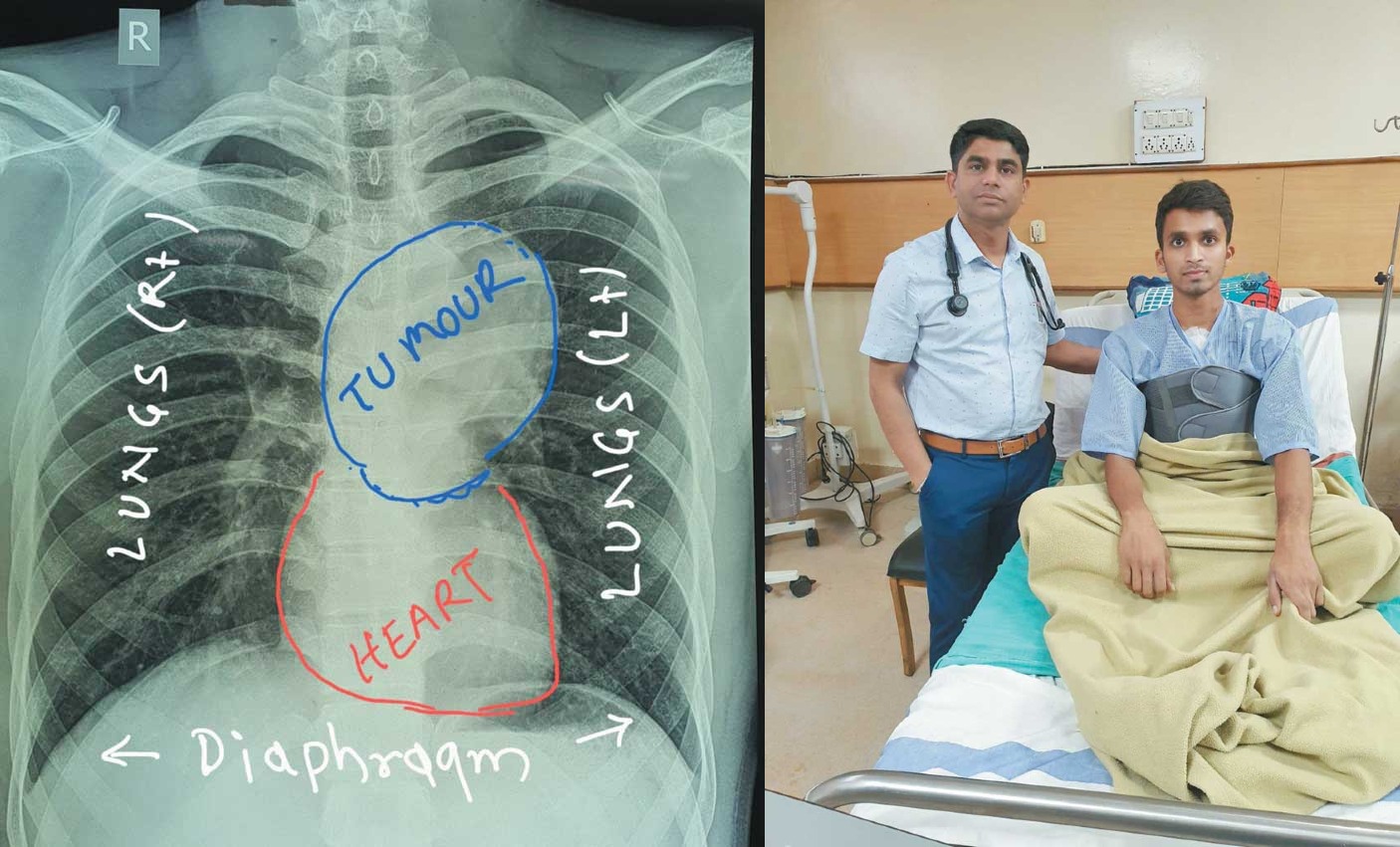   युवक को दो महीने से खांसी, सांस लेने में हो रही थी परेशानी, अम्बेडकर में सर्जरी कर बचाया
