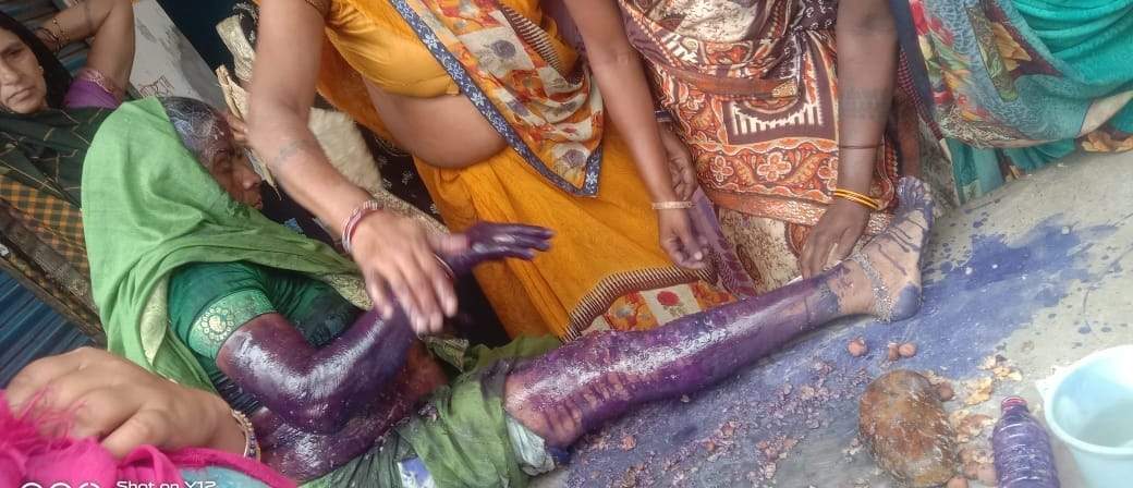 गैस सिलेंडर विस्फोट से झुलसी बुजुर्ग महिला 