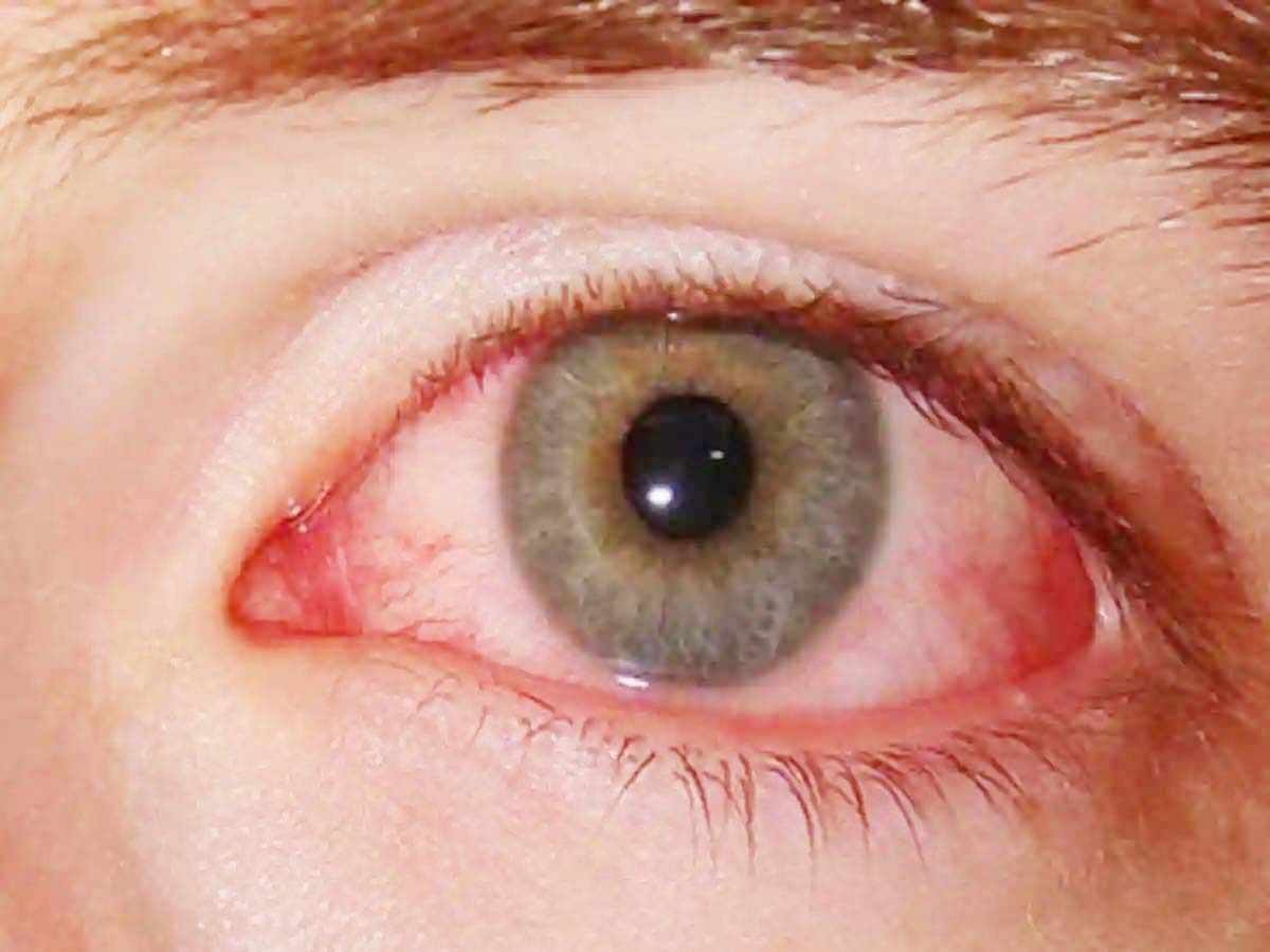 आई फ्लू, संक्रमितों की जांच-सामान्य उपचार तत्काल करने निर्देश