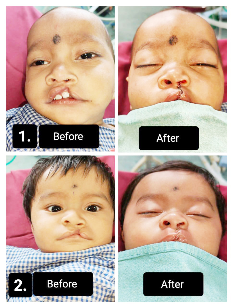 चिरायु ने लौटाई नन्हें दारविश और शिवम की  मुस्कान