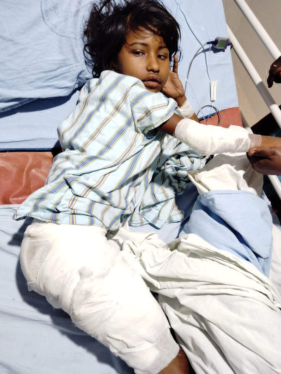 झुलसी बालिका का अब मेडिकल कॉलेज रायपुर में होगा इलाज