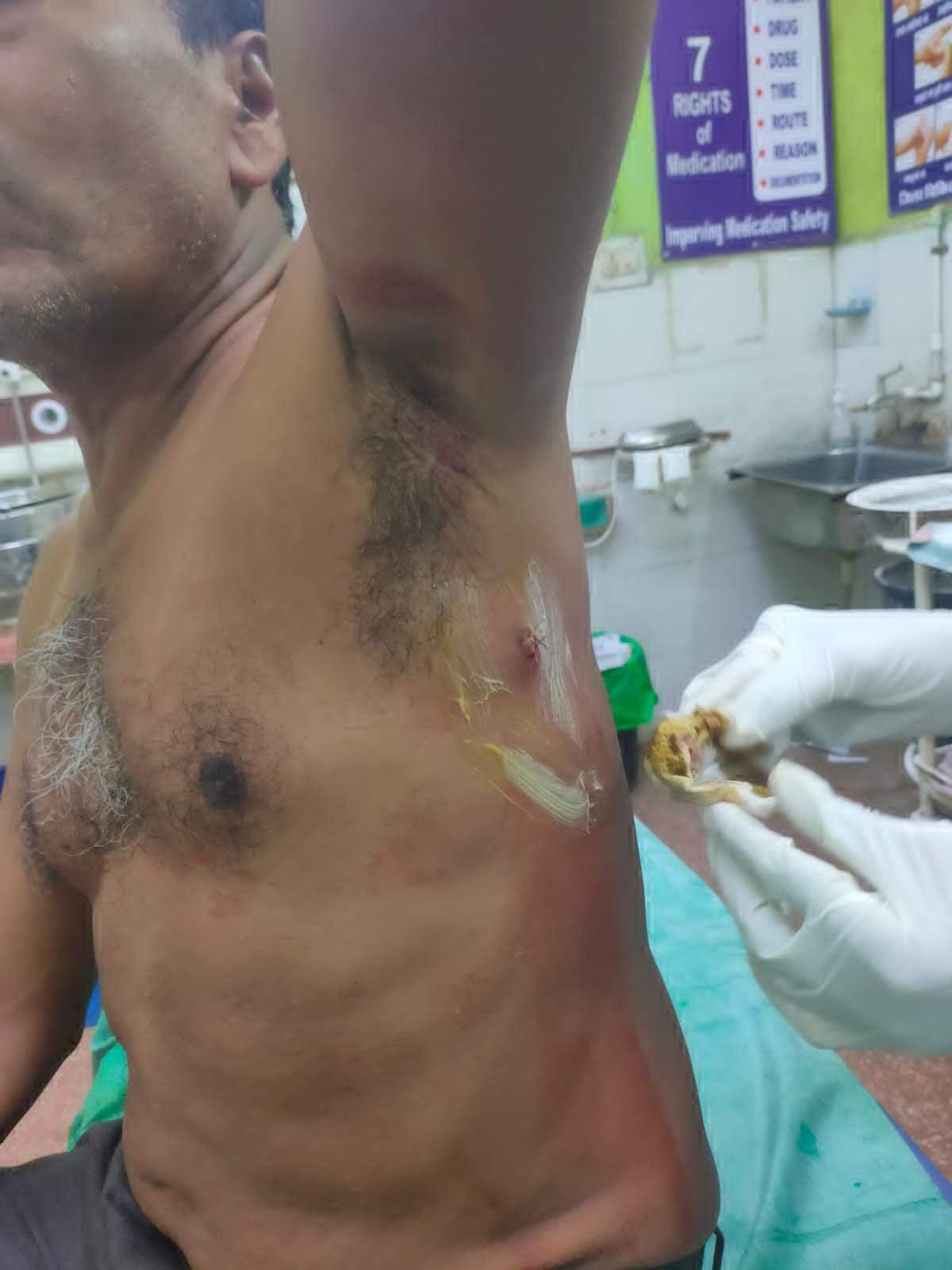 मुजगहन ओवरब्रिज के नीचे चाकूबाजी, घायल 