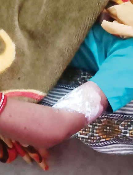 गर्म तेल से बहू को झुलसाया, पति और ससुराल वालों पर मामला दर्ज