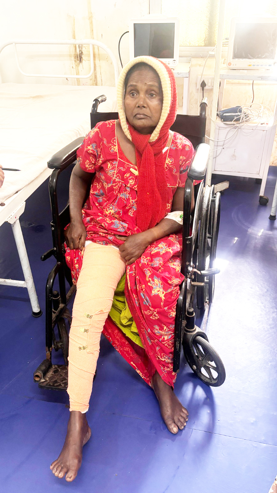 जिला अस्पताल के डॉक्टरों ने नी  रिप्लेसमेंट कर बनाया कीर्तिमान