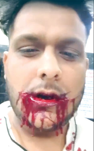 चाइनीज मांझे से युवक के गालों में 34 टांके